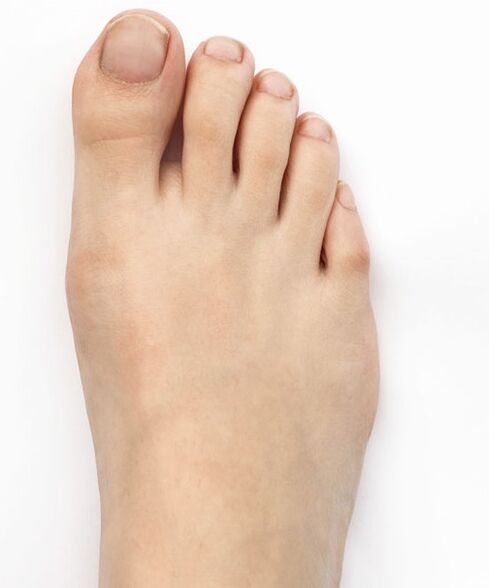 Izliječila sam valgus palca Hondro Sol Valgus sprejom