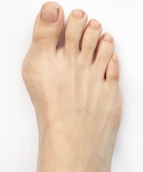 hallux valgus prije upotrebe Hondro Sol Valgus spreja