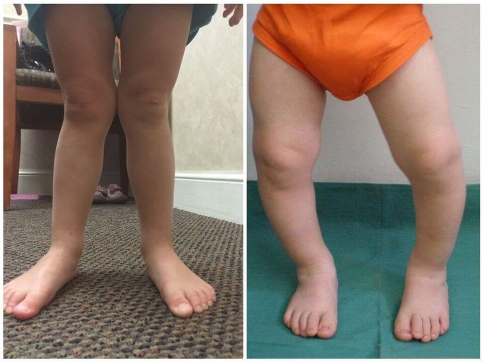 Valgus deformacija kod djece uzrokuje