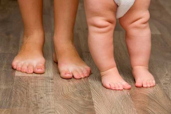 Valgus deformacija kod djece