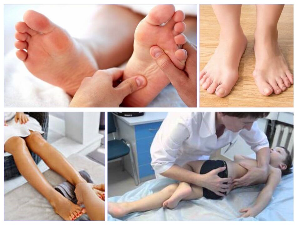 Valgus deformacija u liječenju djece
