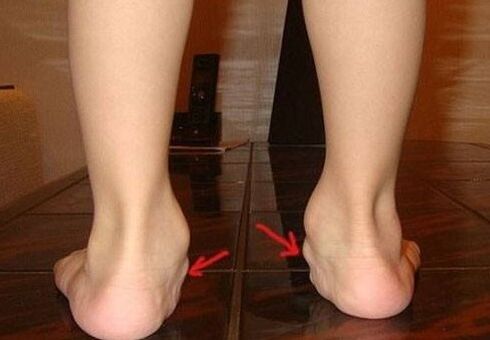 Valgus deformacija stopala kod djece