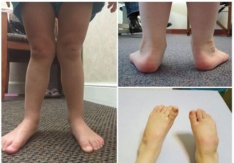 Valgus deformacija kod djece