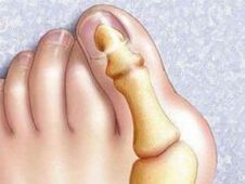 Hallux valgus deformitet